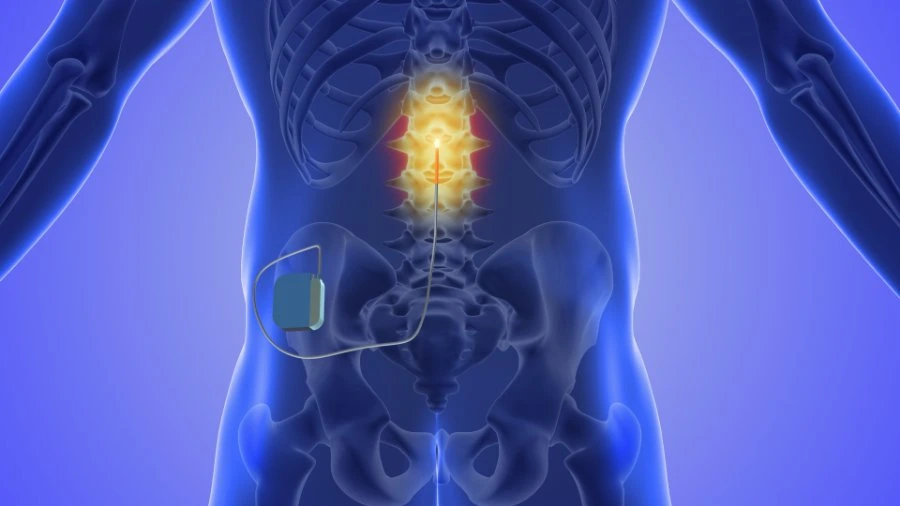Living With a Spinal Cord Stimulator: What You Should Know