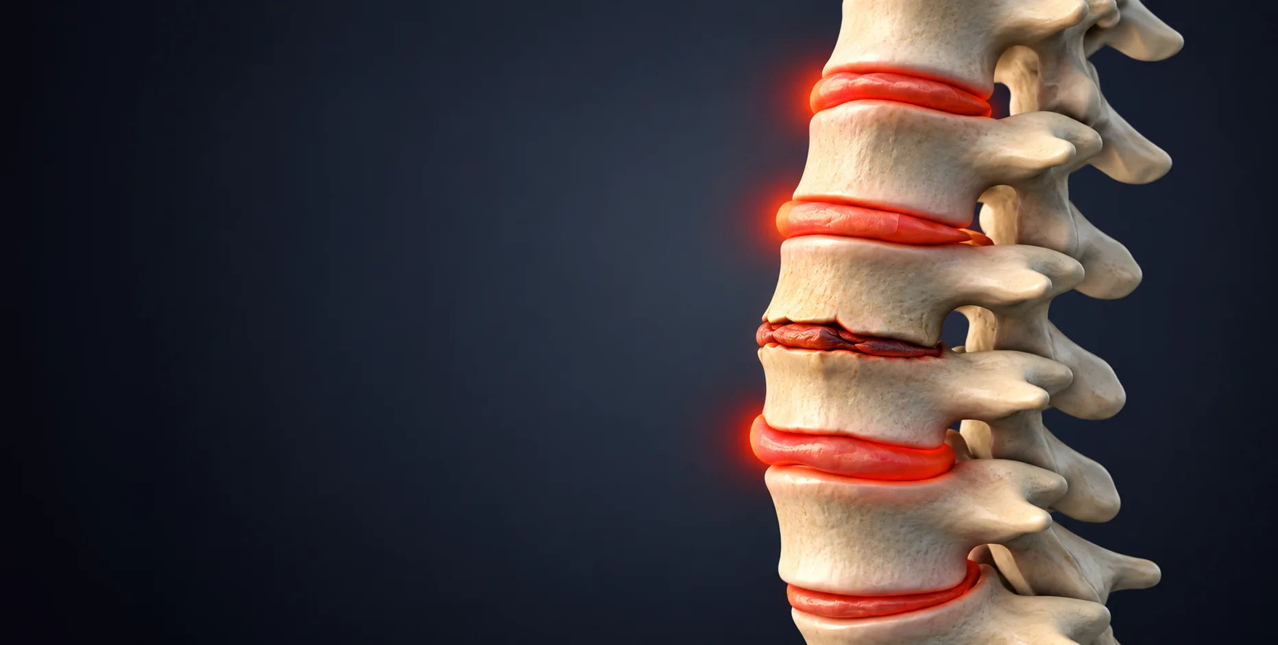 Degenerative disc disease affecting the spinal discs